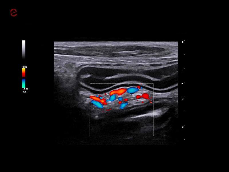 csm_esaote-mylab-falcon-intestine-color-flow