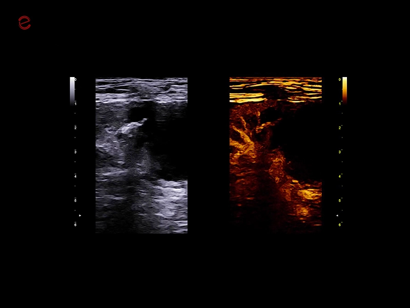 csm_esaote-mylab-falcon-kidney-CnTi
