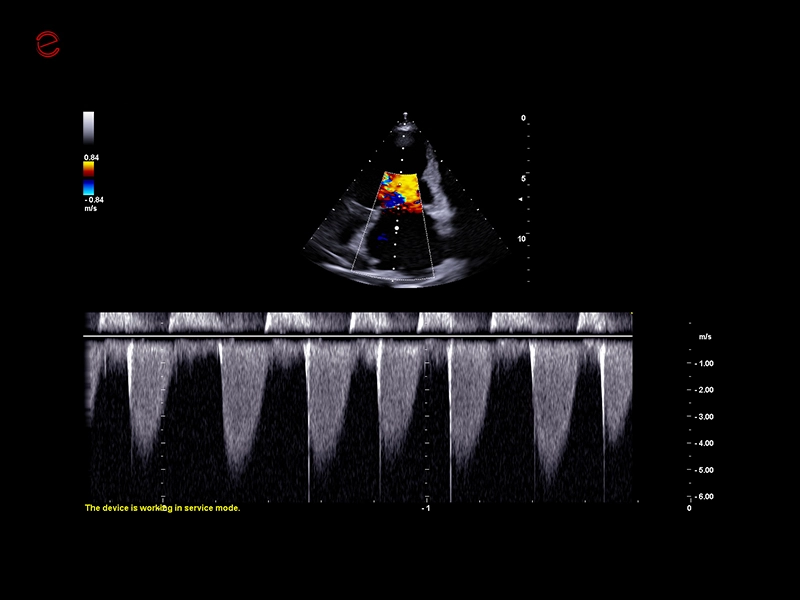 csm_esaote-mylab-falcon-mitral-valve-CW